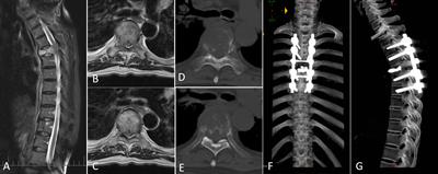 Prediction of postoperative health-related quality of life among patients with metastatic spinal cord compression secondary to lung cancer